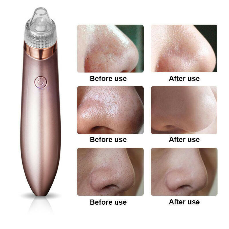 Emporium Pore Vacuum Suction Cleaner | Electric Blackhead & Pimple Remover for Smooth Skin